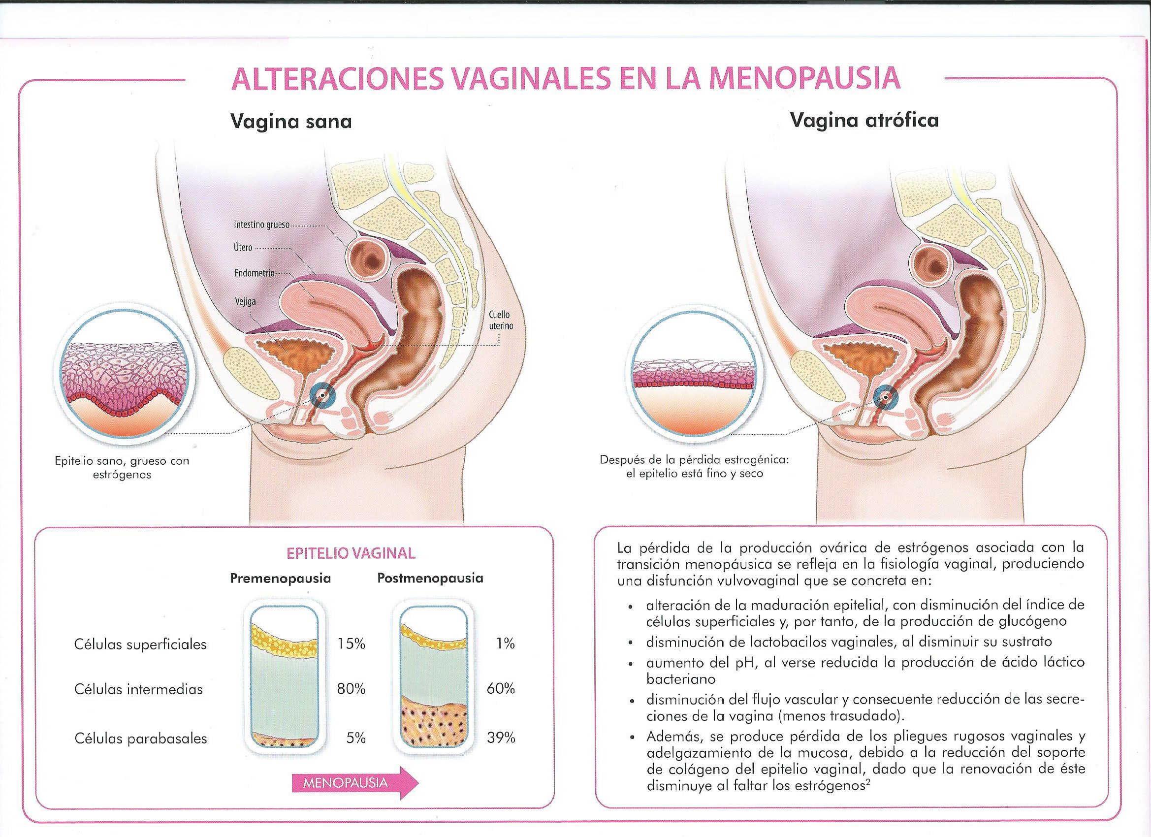 Alteraciones vaginales en la menopausia