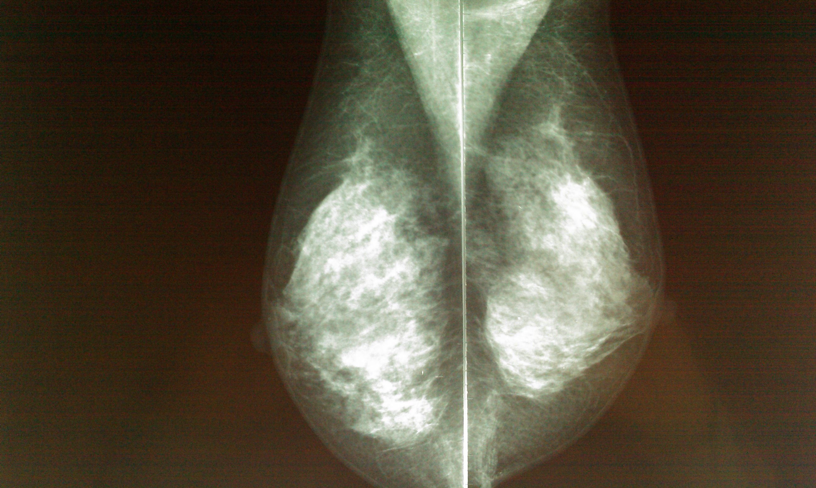 Mamografía NORMAL