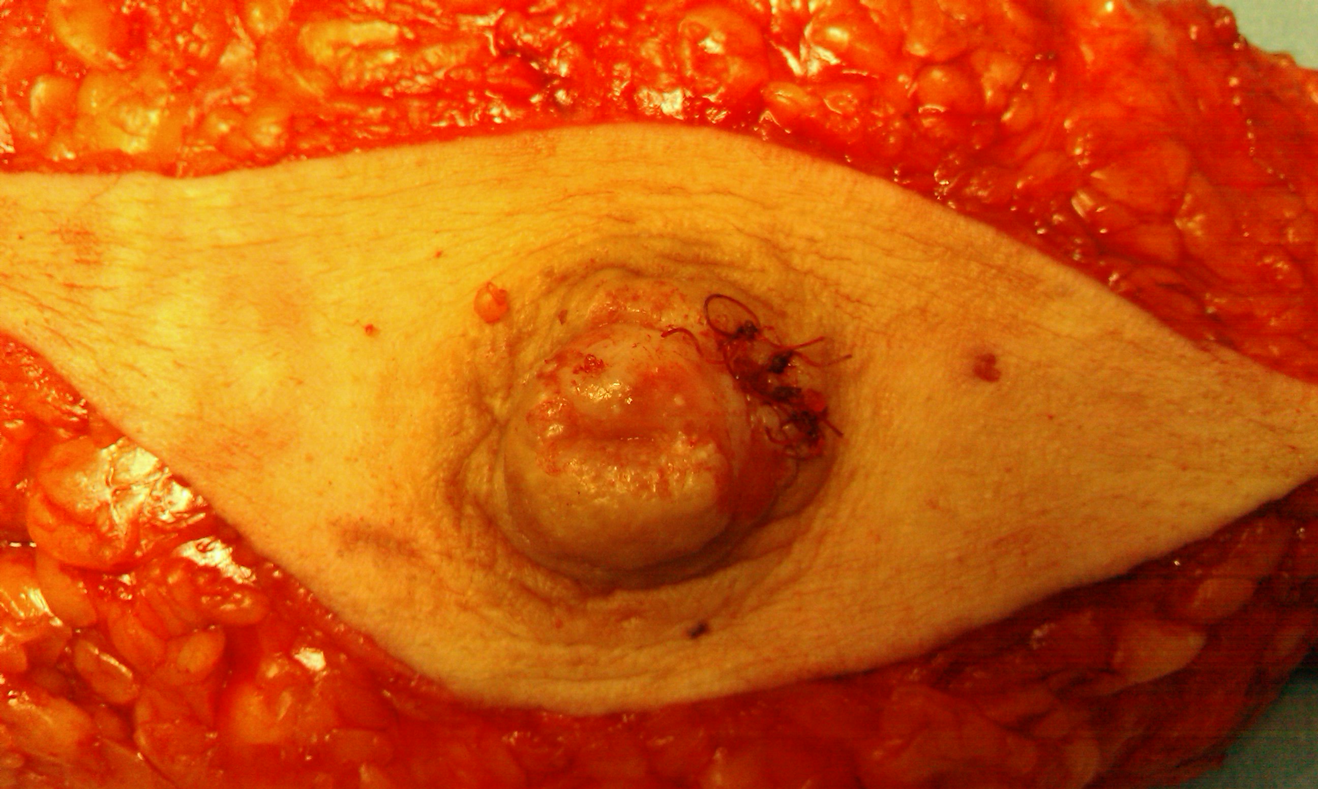 Pieza de mastectomia (Madden)