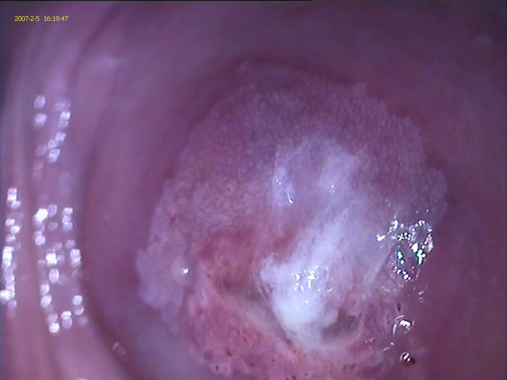 MOSAICO, lesión típica de la infección por HPV