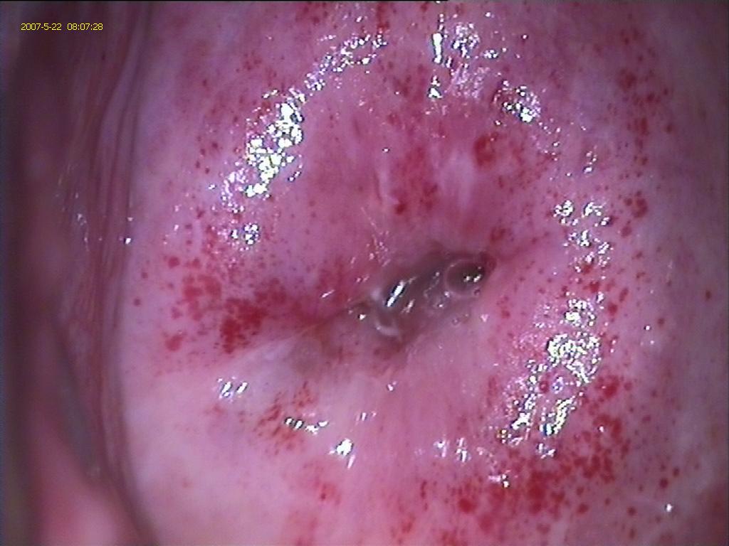 Mucosa petequial (típica en menopausia)