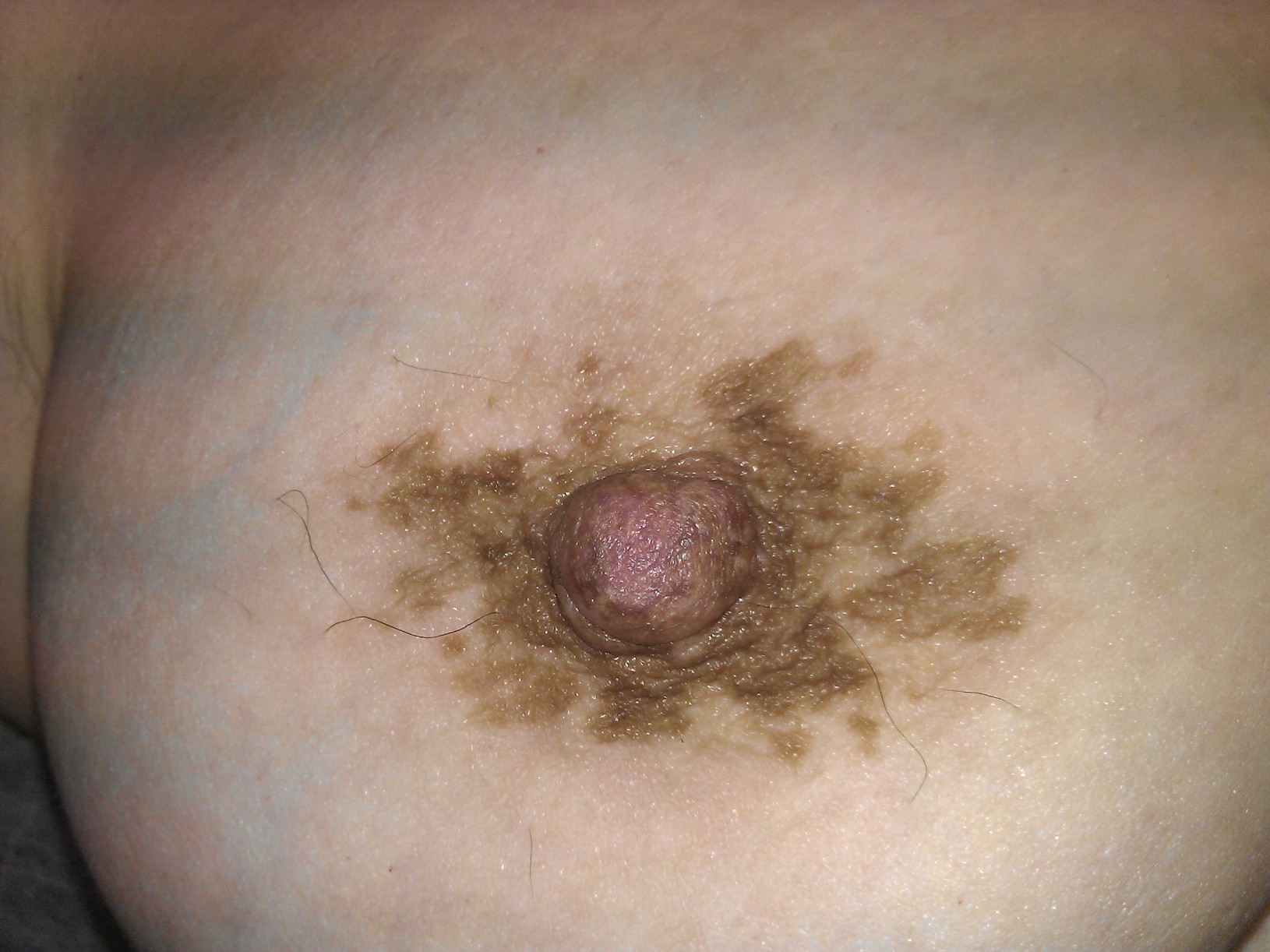 vitiligo de areola