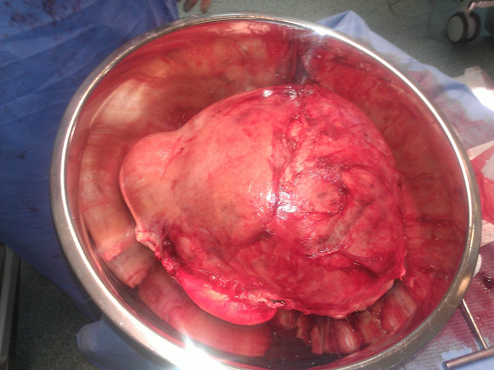 Enorme utero miomatoso que peso 5 Kgs y medio