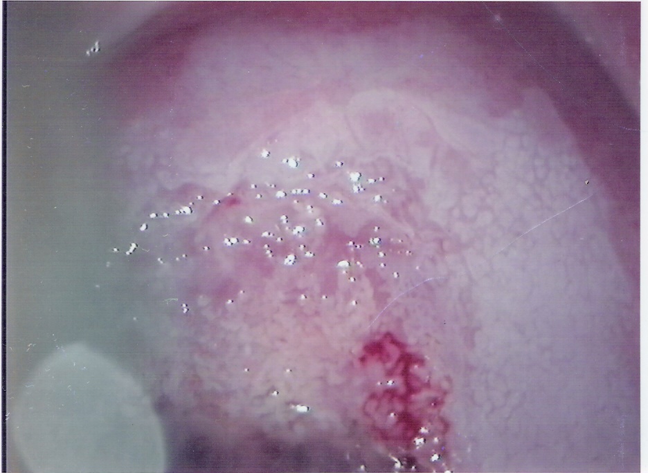 Colposcopia: MOSAICO. Lesión por HPV