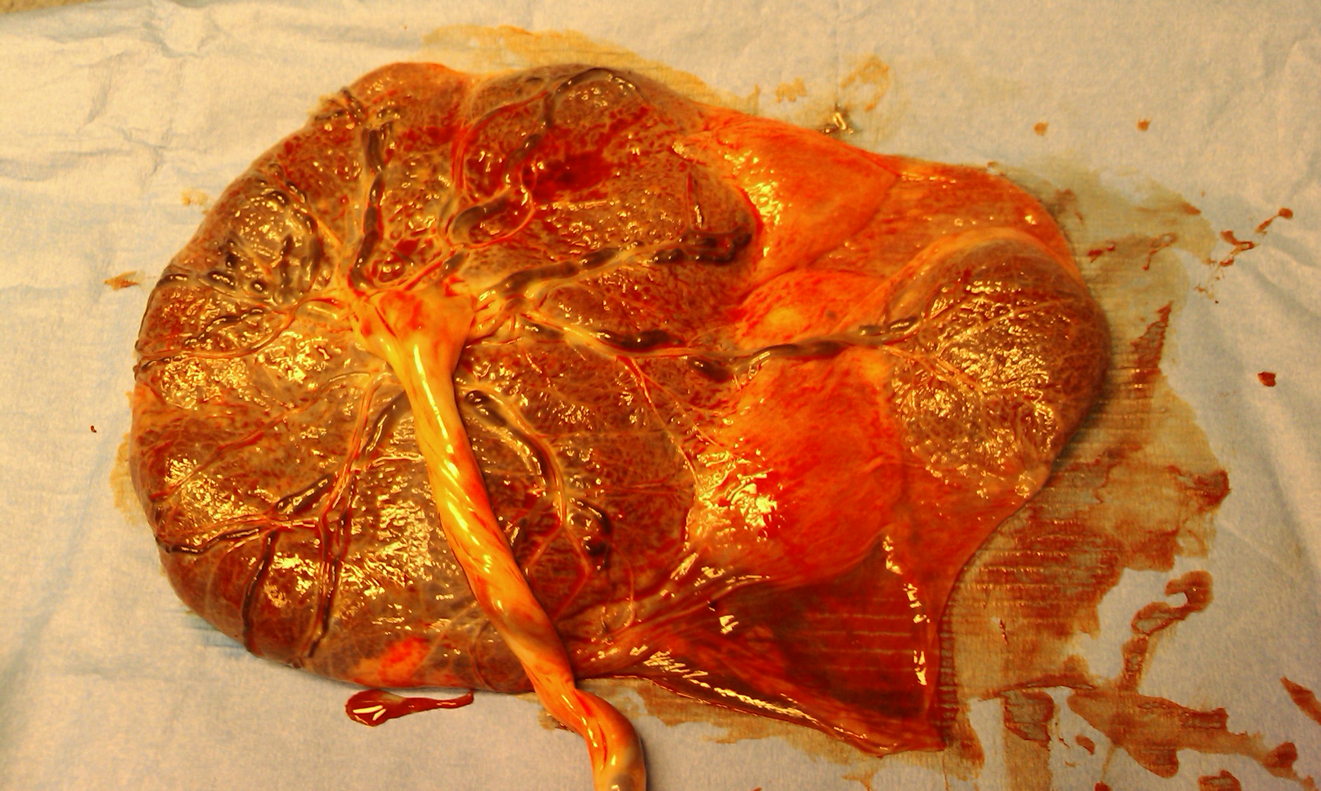 Patología Obstétrica: PLACENTA CON COTILEDON ABERRANTE