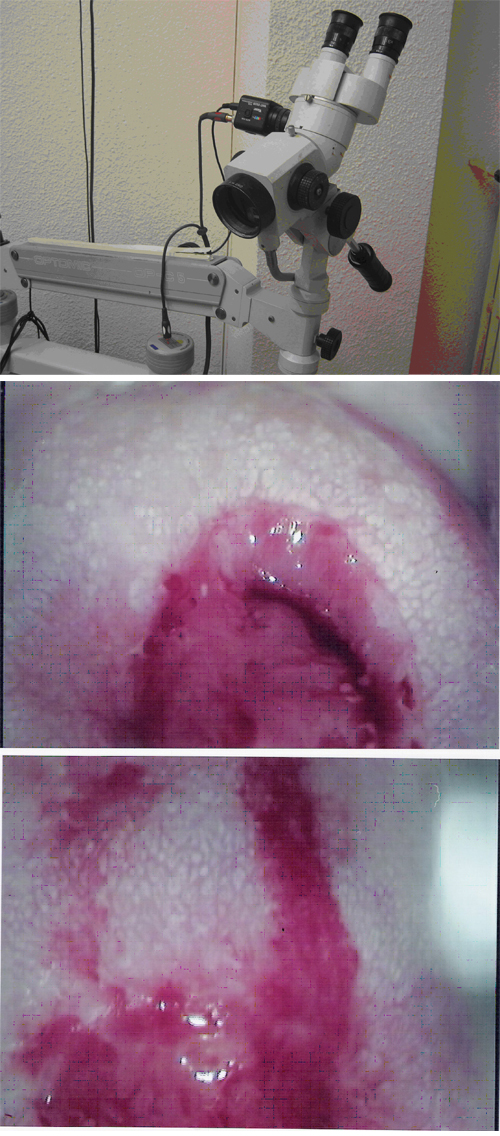 COLPOSCOPIA