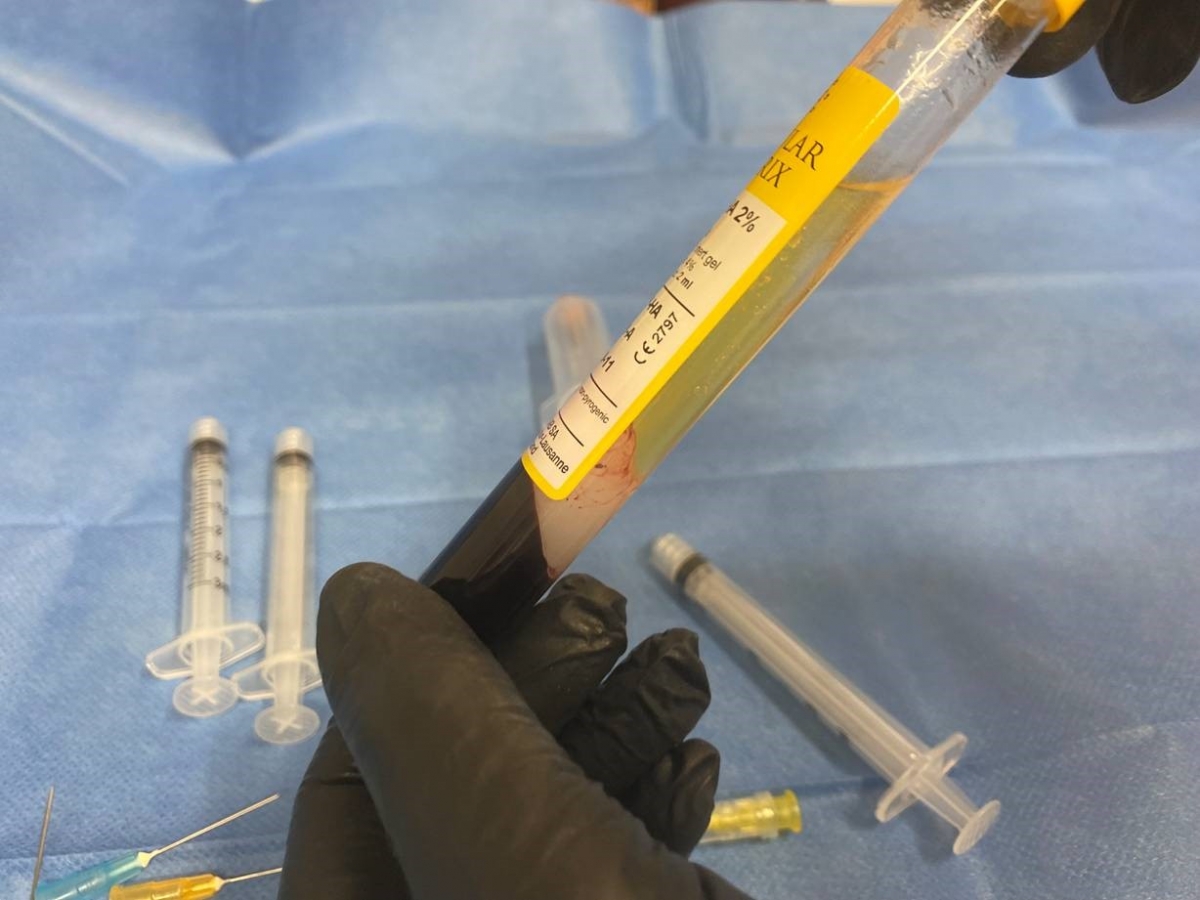PRP (plasma rico en plaquetas)
